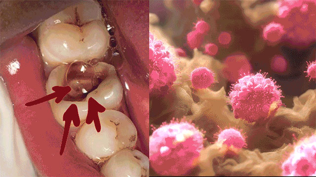 Oral bacteria and tooth decay visualization