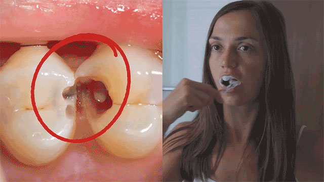 Tooth sensitivity and decay